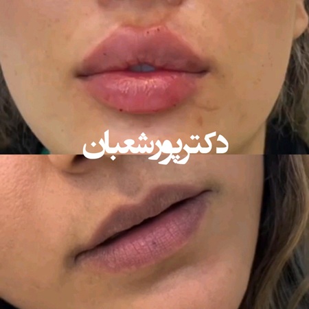 تزریق ژل لب مدل روسی مشهد